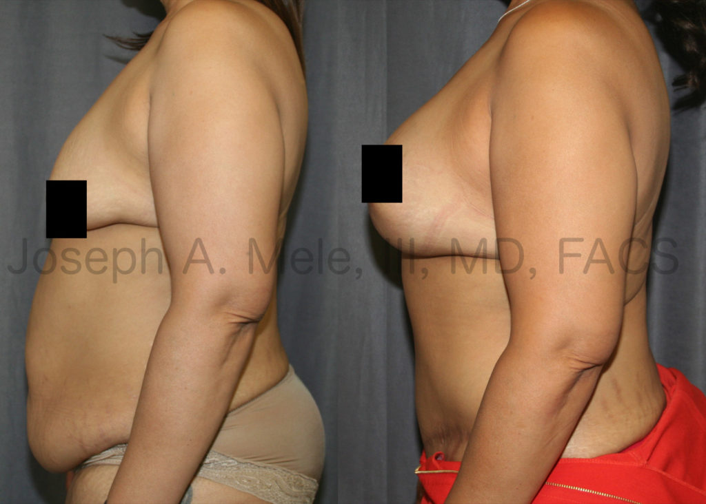 Massive weight loss will shrink our volume, but does not reliably shrink our skin. In the before and after pictures above, breast volume is restored with breast implants. Sagging breast skin is tightened with a breast lift. Excess abdominal skin is removed, and the belly bulge caused by stretched out abdominal muscles is flattened by tightening the muscle sheath.