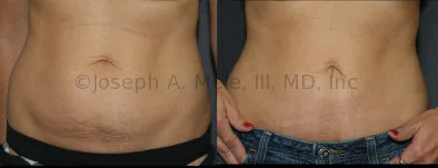 Mini Tummy Tuck Video (Mini Abdominoplasty) - SF Bay Area - 27 