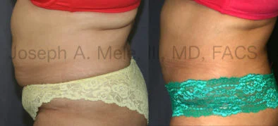 Mini Tummy Tuck San Francisco Bay Area Walnut Creek, CA