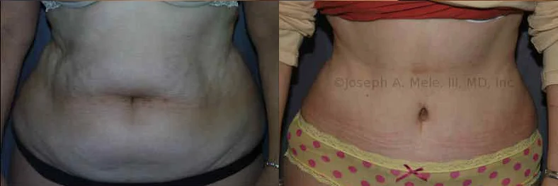 Tummy Tuck San Francisco Bay Area  Schedule A Consultation At Elite  Transformations