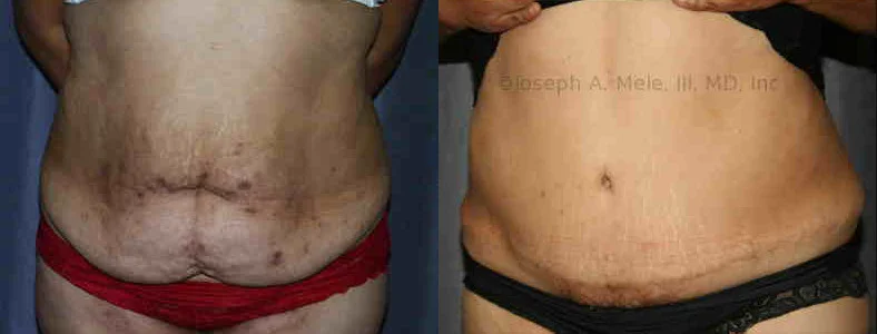 Best Tummy Tuck Scar Encino & Bakersfield