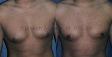 Nipple & Areola Reduction Scottsdale