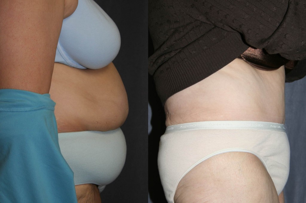 Post Bariatric Plastic Surgery - Tummy Tuck (Abdominoplasty) Post Bariatric Plastic Surgery - Tummy Tuck (Abdominoplasty)